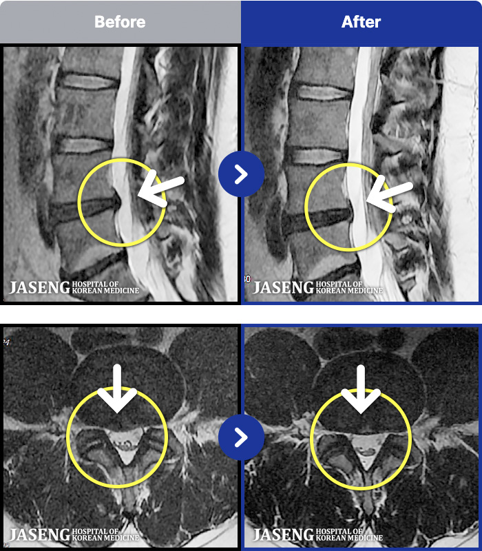 목동자생한방병원 치료 전후 MRI 비교 이미지