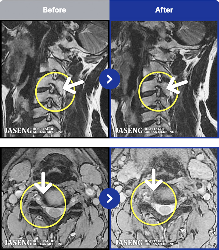 목동자생한방병원 치료 전후 MRI 비교 이미지
