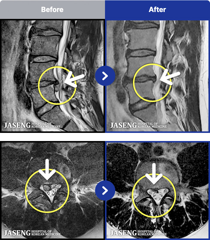 목동자생한방병원 치료 전후 MRI 비교 이미지