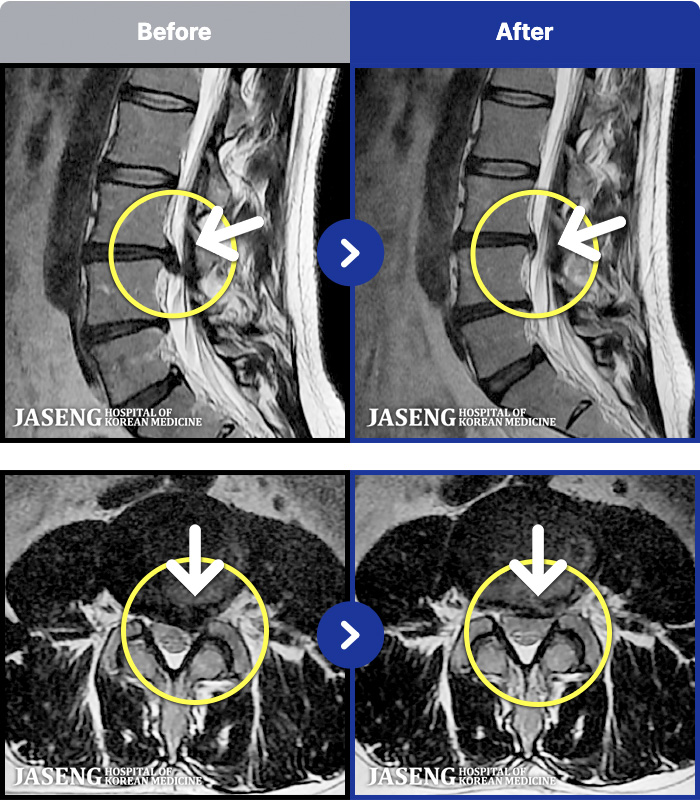 목동자생한방병원 치료 전후 MRI 비교 이미지
