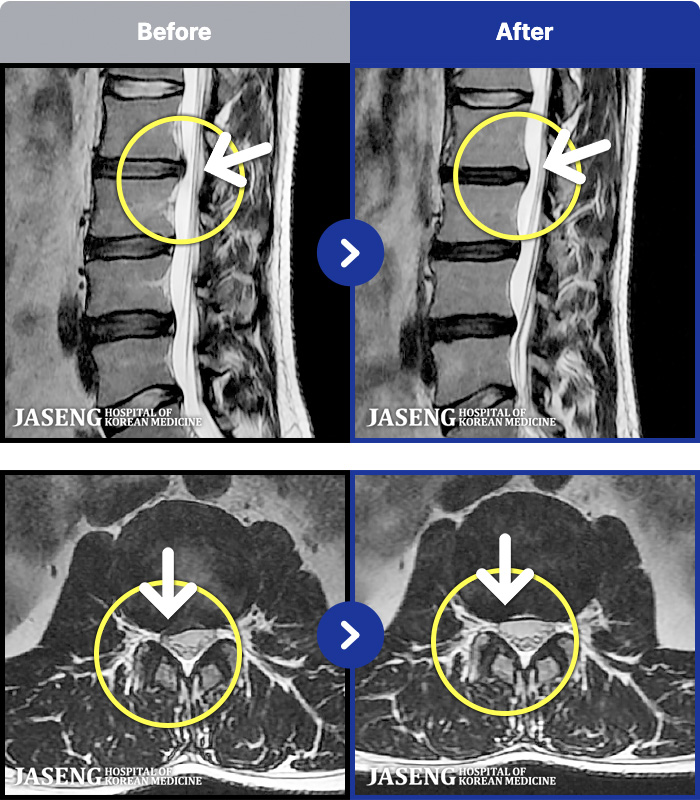 목동자생한방병원 치료 전후 MRI 비교 이미지