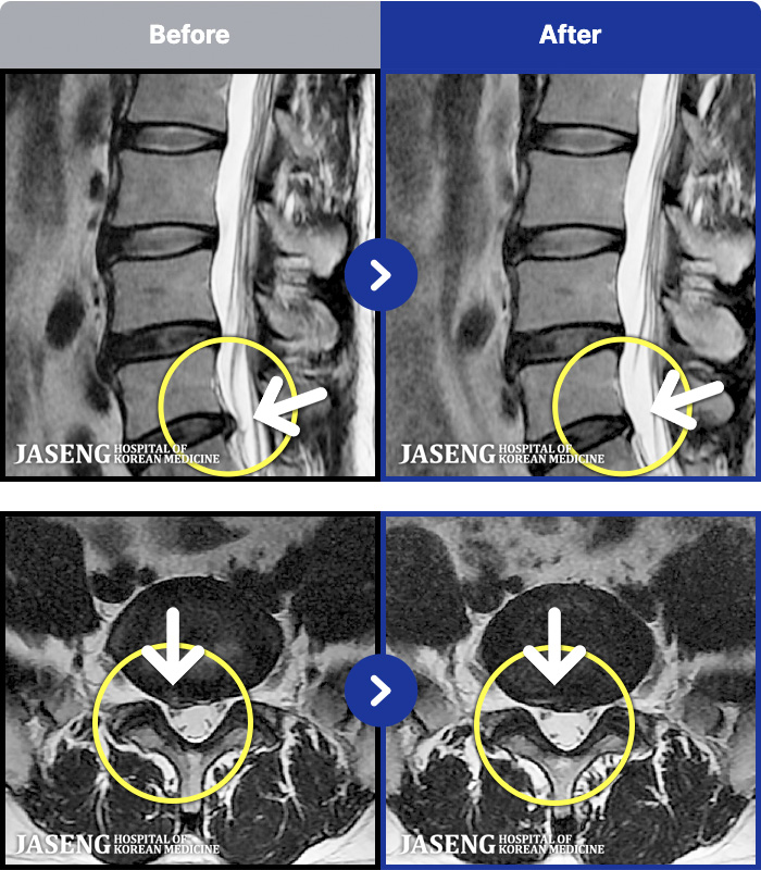 목동자생한방병원 치료 전후 MRI 비교 이미지