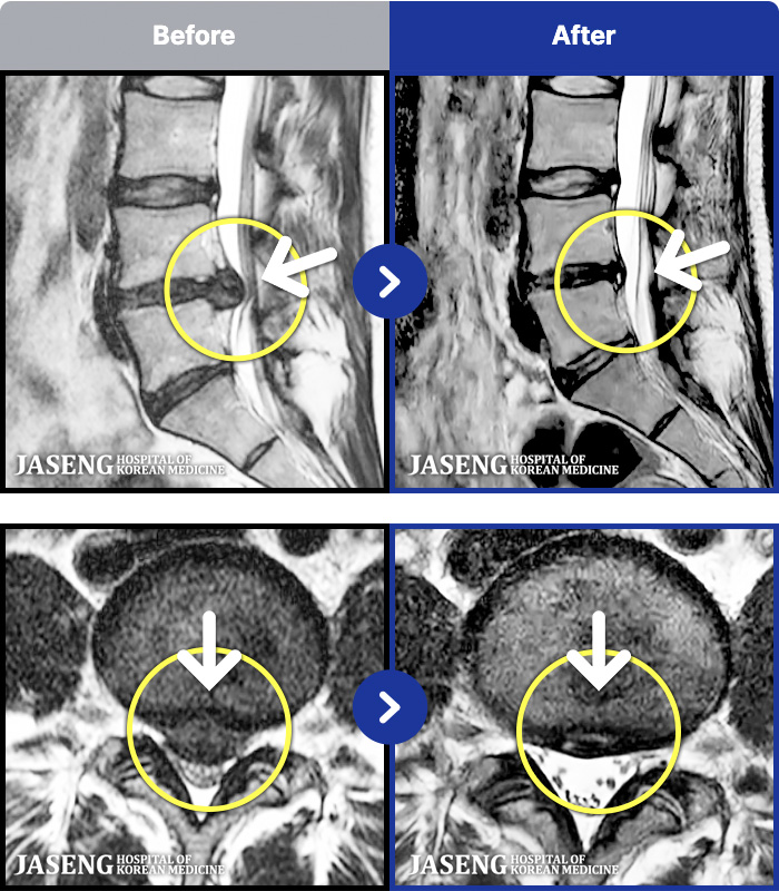 자생한방병원 치료 전후 MRI 비교 이미지