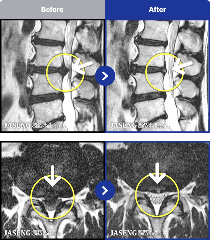 자생한방병원 치료 전후 MRI 비교 이미지