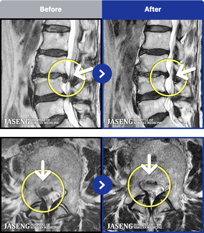 자생한방병원 치료 전후 MRI 비교 이미지