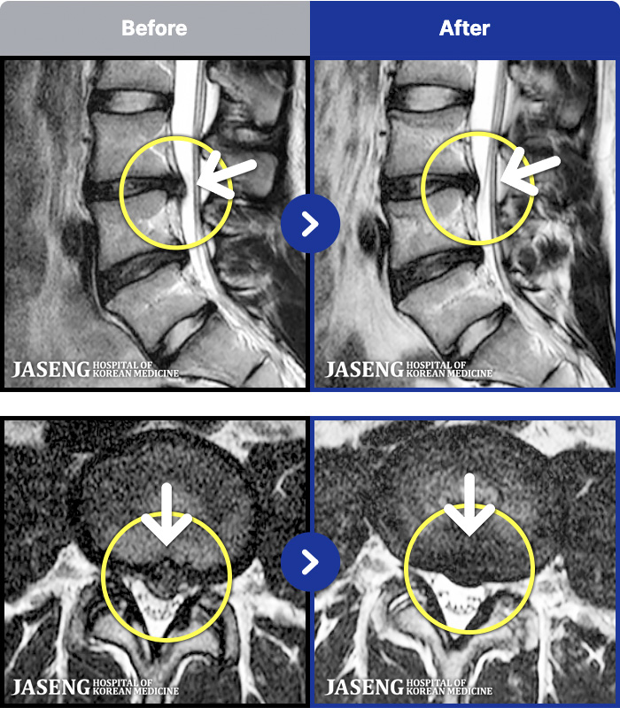 자생한방병원 치료 전후 MRI 비교 이미지