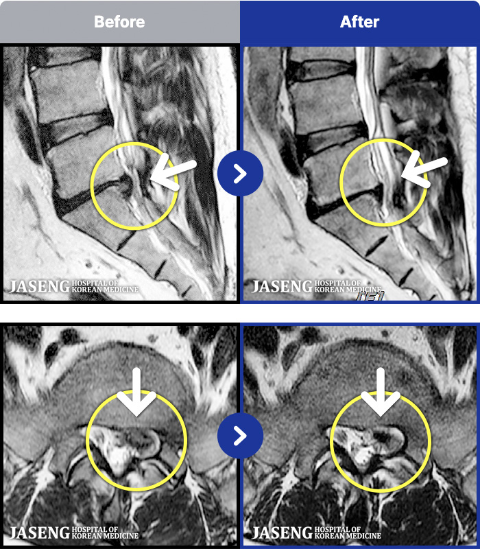 자생한방병원 치료 전후 MRI 비교 이미지