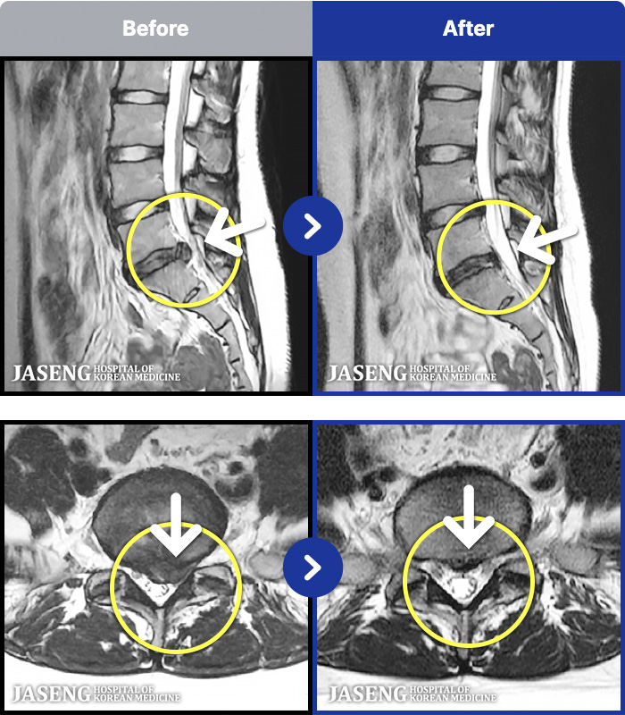 자생한방병원 치료 전후 MRI 비교 이미지