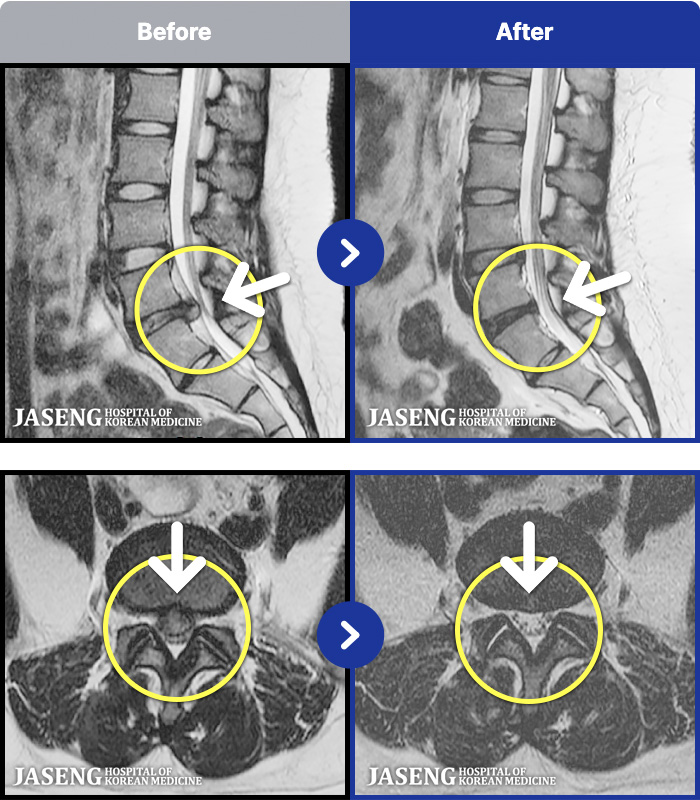 인천자생한방병원 치료 전후 MRI 비교 이미지