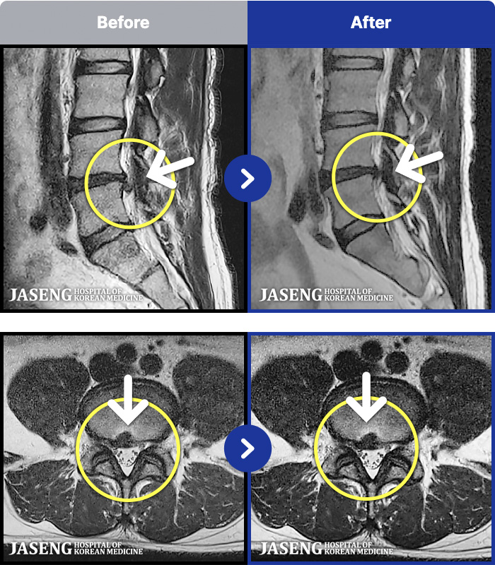 일산자생한방병원 치료 전후 MRI 비교 이미지