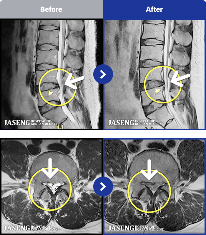 광주자생한방병원 치료 전후 MRI 비교 이미지