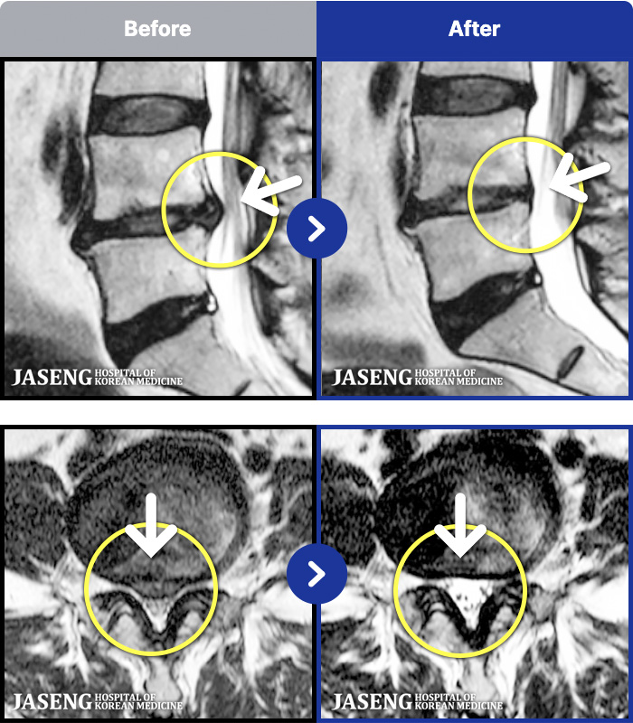 자생한방병원 치료 전후 MRI 비교 이미지