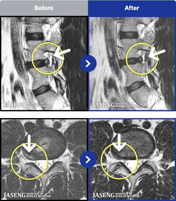 자생한방병원 치료 전후 MRI 비교 이미지