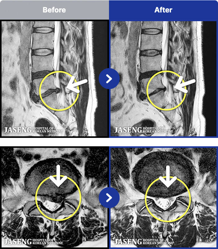 자생한방병원 치료 전후 MRI 비교 이미지
