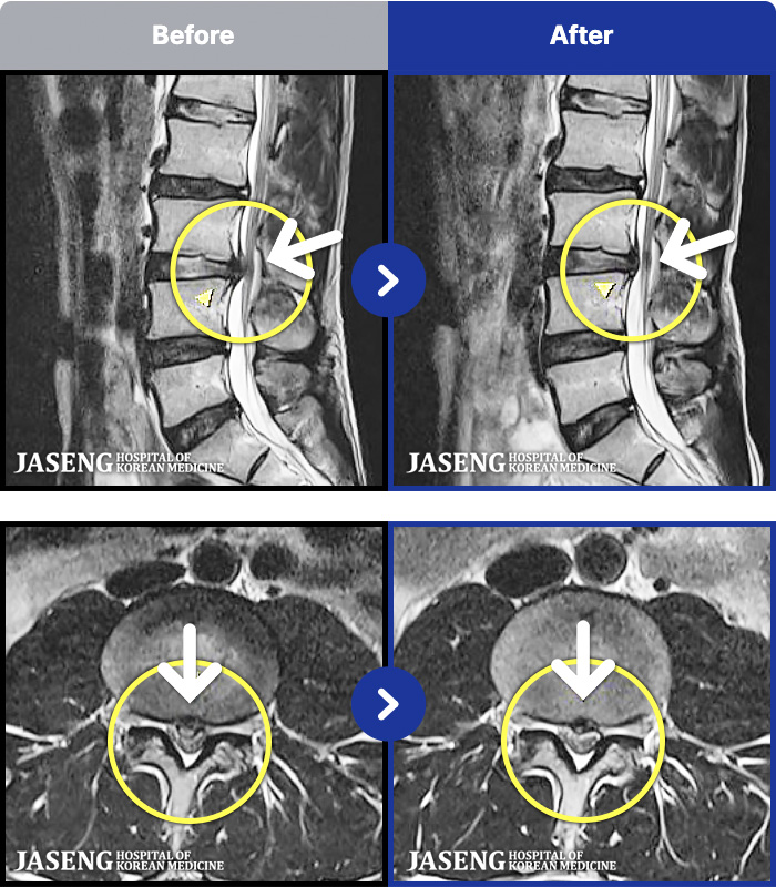 광주자생한방병원 치료 전후 MRI 비교 이미지