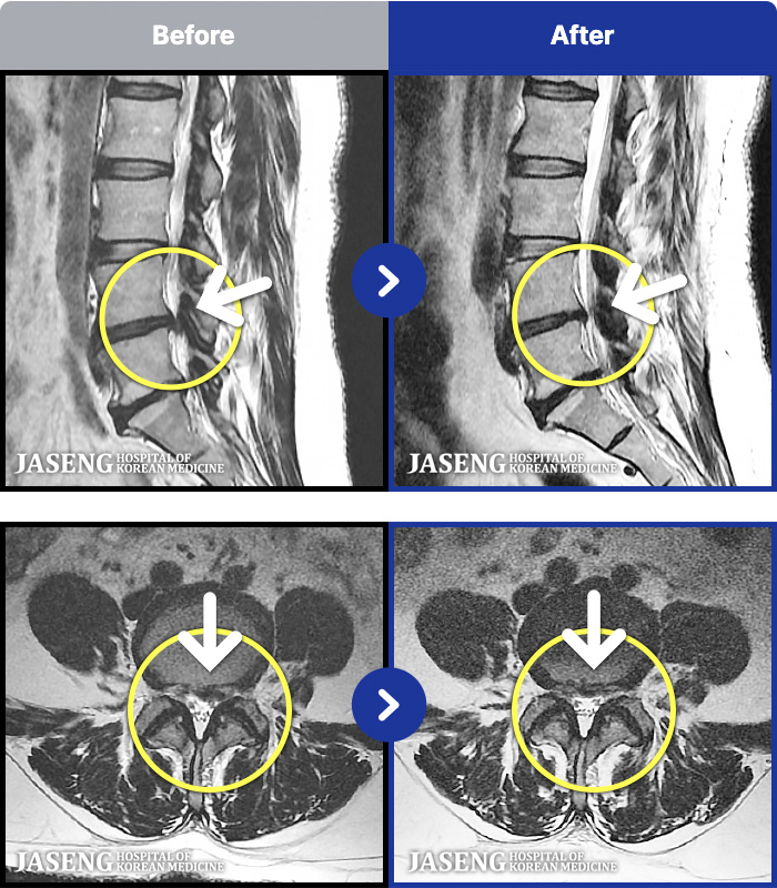 대전자생한방병원 치료 전후 MRI 비교 이미지