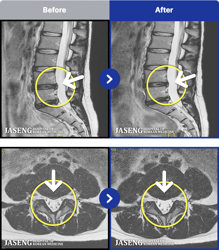 인천자생한방병원 치료 전후 MRI 비교 이미지
