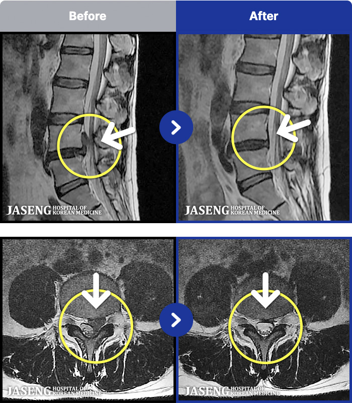 일산자생한방병원 치료 전후 MRI 비교 이미지