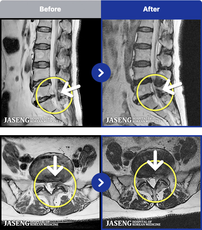 일산자생한방병원 치료 전후 MRI 비교 이미지