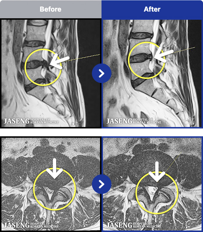 부천자생한방병원 치료 전후 MRI 비교 이미지
