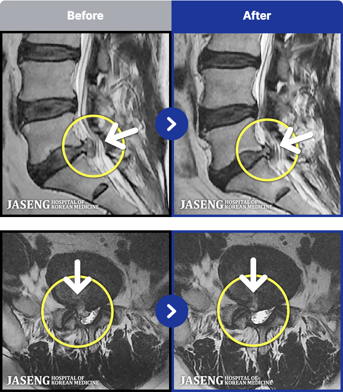 부천자생한방병원 치료 전후 MRI 비교 이미지