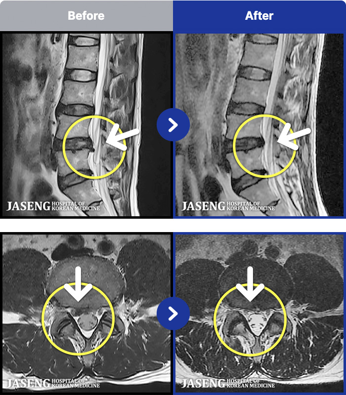 일산자생한방병원 치료 전후 MRI 비교 이미지