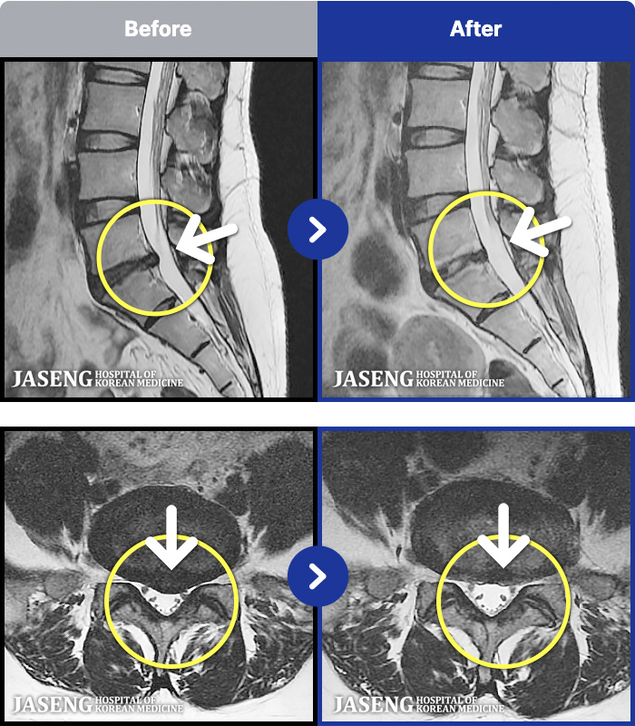 대전자생한방병원 치료 전후 MRI 비교 이미지