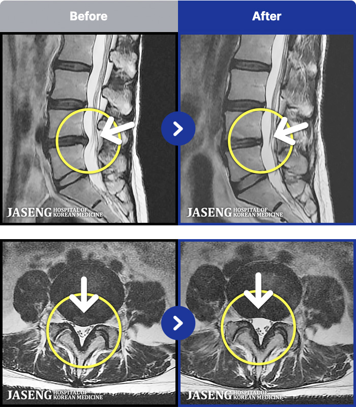 대전자생한방병원 치료 전후 MRI 비교 이미지