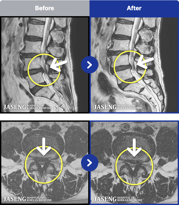 인천자생한방병원 치료 전후 MRI 비교 이미지