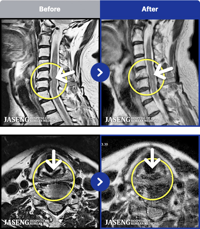인천자생한방병원 치료 전후 MRI 비교 이미지