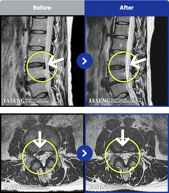 일산자생한방병원 치료 전후 MRI 비교 이미지