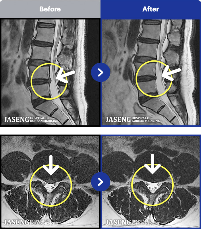 대전자생한방병원 치료 전후 MRI 비교 이미지