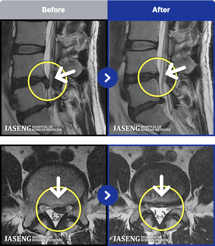 부천자생한방병원 치료 전후 MRI 비교 이미지