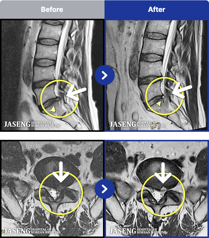 광주자생한방병원 치료 전후 MRI 비교 이미지