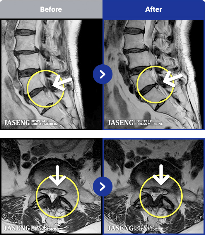 해운대자생한방병원 치료 전후 MRI 비교 이미지