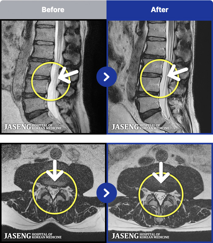 인천자생한방병원 치료 전후 MRI 비교 이미지
