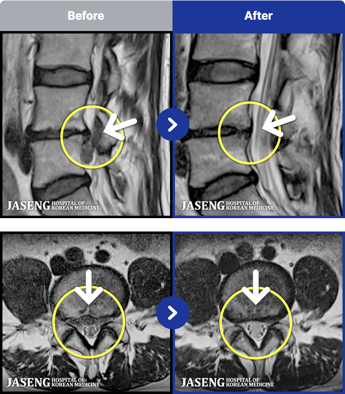 대구자생한방병원 치료 전후 MRI 비교 이미지