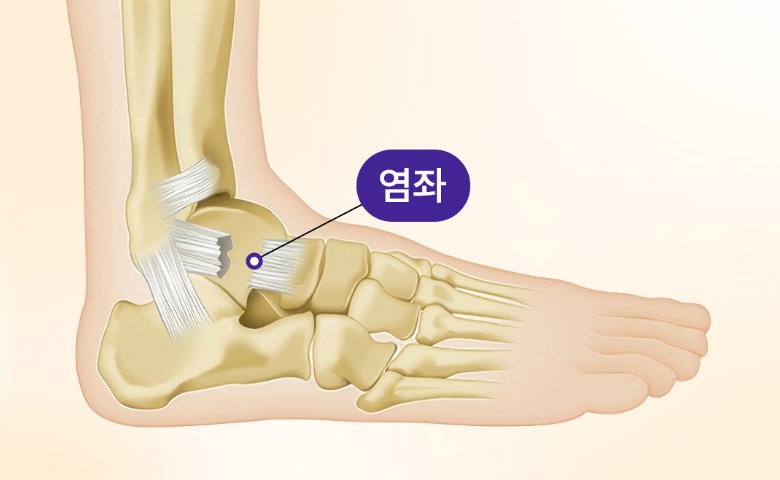 인대 파열된 발 일러스트